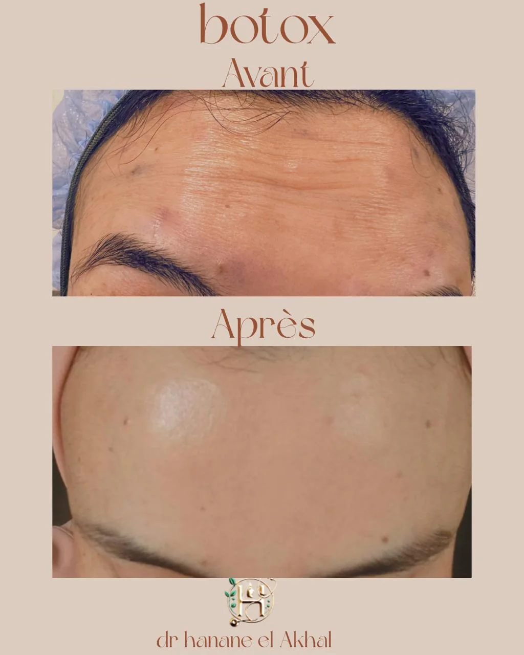 Résultat avant et après un traitement Botox du front
